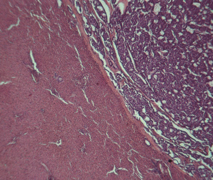 Imagen: Microfotografía de luz de un carcinoma metastásico en el hígado humano, mostrando células hepáticas normales y células tumorales malignas (Fotografía cortesía de John Burbidge / SPL).